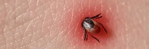 Tick bite